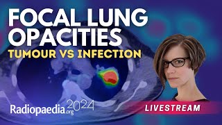 Focal lung opacities tumour vs infection with​ Miranda Siemienowicz [upl. by Estel]