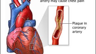 Prinzmetal angina symptoms amp treatment [upl. by Keeler489]