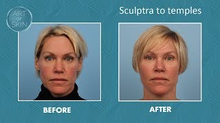 Sculptra injection to temples [upl. by Olnton734]