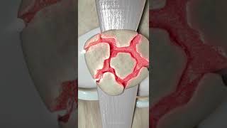 Comminuted Displaced Patella Fracture [upl. by Edva]