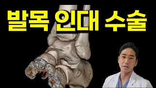 발목 인대 파열 수술은 이렇게 합니다 modified brostrom operation MBO [upl. by Anoiek]