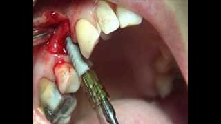 Dental Implants by using bone graft and membrane leader Italia Tixos DrPalmieri [upl. by Nohcim979]