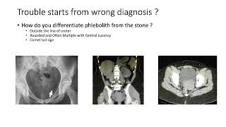 Phlebolith vs Lower Ureteric Stone  How to Diffrentiate [upl. by Nalo]