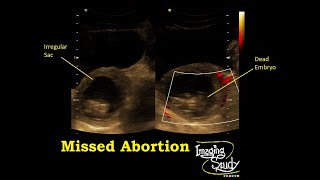 Missed Abortion  Ultrasound  Case 34 [upl. by Najram412]