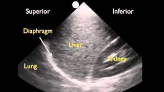 How To Ultrasound Detection of Pleural Fluid Case Study Video [upl. by Weinshienk57]