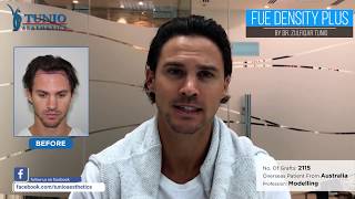 Australian Model Sharing His Review After 5 months of FUE Hair Transplant at Tunio Aesthetics [upl. by Biddy664]