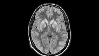 Case discussion Hypoxic Ischaemic Encephalopathy HIE [upl. by Jecoa]