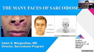 The Many Faces of Sarcoidosis [upl. by Hobard]