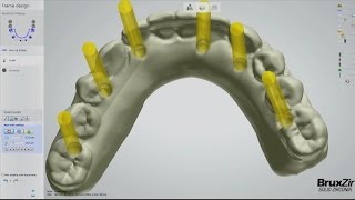 Fabrication of the BruxZir® FullArch Implant Prosthesis Vol 1 Issue 2 [upl. by Oberstone791]