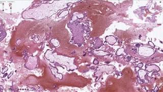 Products of Conception  Histopathology [upl. by Azeret]