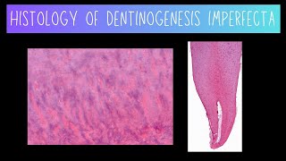 Histology of Dentinogenesis Imperfecta [upl. by Elleivad155]