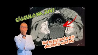 CÁLCULO NA JUV IMPORTÂNCIA EM FAZER EM DECÚBITO VENTRAL [upl. by Chadbourne600]