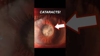 Doctor Explains How CATARACTS Form 👁️☁️ [upl. by Odranar]