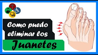 JUANETES en los pies como ELIMINARLOS [upl. by Brigida]