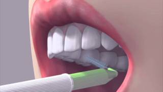 How to use an interdental brush [upl. by Philander]