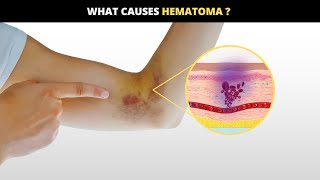 Unveiling Hematomas  Causes Symptoms amp Solutions [upl. by Siuqaj420]