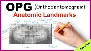 Orthopantomogram OPG Anatomical Landmarks  Radiology [upl. by Fesoy]