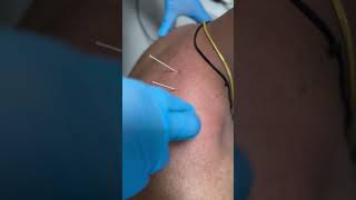 Dryneedling therapy for neck pain payal dryneedling ytshorts doctor physicaltherapy [upl. by Andreas529]