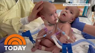 Meet The Surgeon Who Led LifeChanging Procedure To Separate Conjoined Twins [upl. by Maxwell]