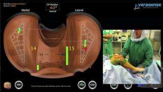 VERASENSE Addressing the Valgus Knee with a PosteriorLateral Release  Stryker Triathlon [upl. by Xenos635]