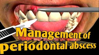 Management of periodontal abscess  Treatment of periodontal abscess  treatment of lateral abscess [upl. by Idham]