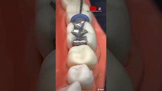 ¡🔥Instalación de separadores dentales y bandas metálicas en las muelas 0🦷0🔥 [upl. by Yrolg913]