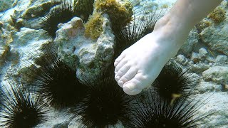 Stung By Sea Urchin Whats Gonna Happen [upl. by Marieann]