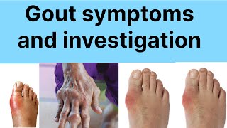 Gout symptoms and investigation  Gout investigation  Gout symptoms [upl. by Ased]