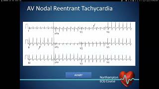 Preexcitation  Dr Jonathan Timperley Consultant Cardiologist Northampton General [upl. by Vicki]