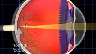 Nearsightedness and Farsightedness [upl. by Abeh]