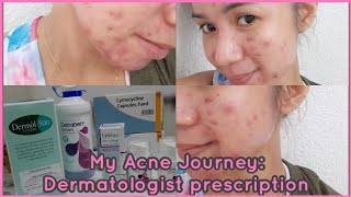 My Acne Journey Lymecycline Capsules Epiduo Gel Dermol 500 amp Cetraben Lotion  Gel Pines [upl. by Nelle]