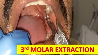 FOUR SIMPLE STEPS IN 3RD MOLAR EXTRACTION IMPACTION UPPER THIRD MOLAR dentalcafe4331 [upl. by Aliehs973]