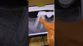 Endodontic retx of tooth 30 [upl. by Barden786]