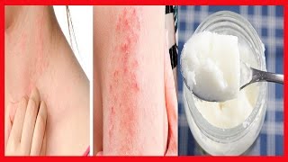 Saiba Como EVITAR Alergias na Pele Por Causa do Calor  Creme Caseiro que Acaba Com ALERGIAS [upl. by Oakleil]