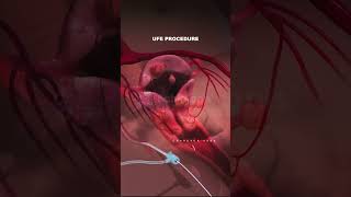 What is Uterine Fibroid Embolization procedure Types of Fibroids fibroid pregnancy animation [upl. by Arul]