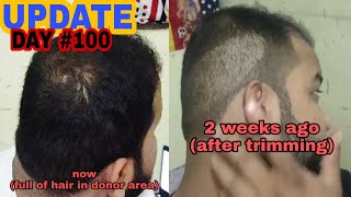 HAIR TRANSPLANT IN INDIA  RESULT DAY 100  SEE MY DONOR AREA [upl. by Marcella]