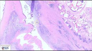 Pancreas Mucinous cystic neoplasm  Microscopy Talking slide [upl. by Naols]