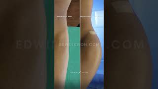 MTF Hip Implant Liposuction Flanks Body Contouring Before And After [upl. by Nitsyrk755]