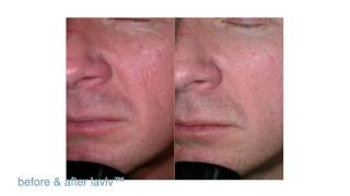 FDAApproved LaViv Fibroblast Treatment  Maryland Laser Skin amp Vein [upl. by Tompkins]