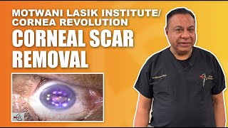 Traumatic Corneal Scar Removal by excimer laser [upl. by Dhaf247]