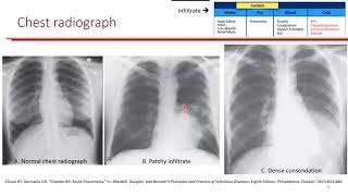 Influenza and CommunityAcquired Pneumonia LO 1 [upl. by Anaitat]