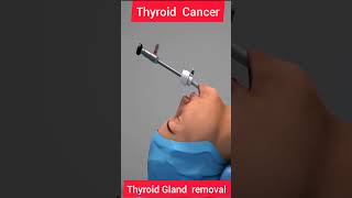 THYROID CANCER  THYROID REMOVAL 3D ANIMATION biologyislife howtogetsuccessinlife getsuccess [upl. by Haik]