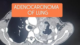 Adenocarcinoma of lung cect ctscan lungs pulmonary radiology hrct cancer carcinoma tumor [upl. by Eniar505]