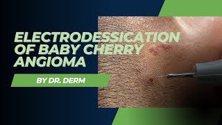 Electrodessication of Baby Cherry Angioma  Dr Derm [upl. by Nnylram513]