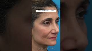 Lower Blepharoplasty  Fat Transfer to MidFace  Skin Tightening  Trifecta Lift  Dr Kami Parsa [upl. by Novart]