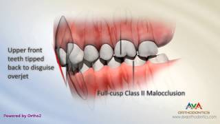 Malocclusion  Class II Div 2 [upl. by Gnaw]