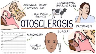 Otosclerosis  Drk [upl. by Ehcar511]