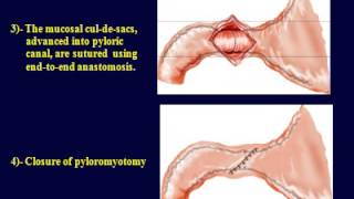 Pyloric atresia reconstruction  Dessanti technique [upl. by Ahsemed91]