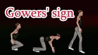 Gower s sign  gowers maneuver  Sign of proximal muscle weakness [upl. by Ennayram822]