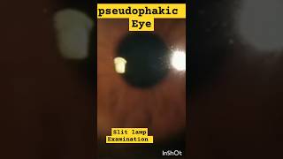 Pseudophakic Eye On Slit Lamp Examination  pseudophakia eyedisease [upl. by Hgielra141]